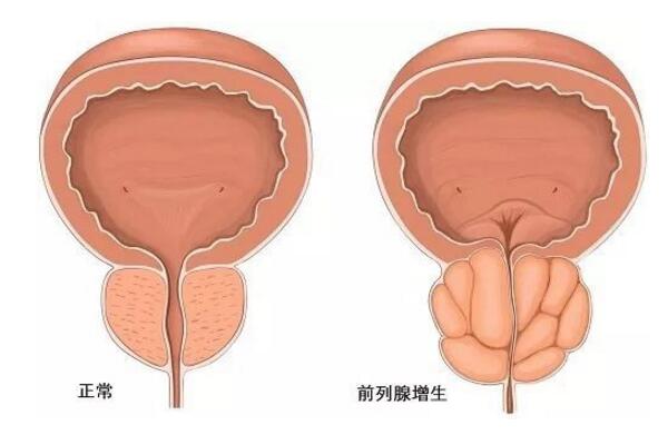 前列腺增生的注意事项