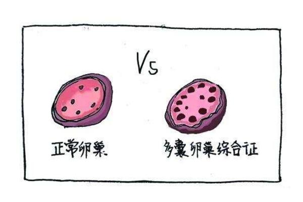 卵巢多囊的症状表现