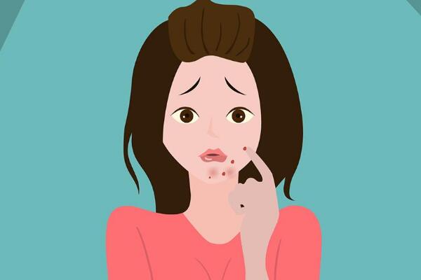 脸上的痤疮怎么消除